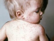 Ministerul Sănătății anunță epidemie de rujeolă în România. Trei copii sub un an au murit și la alți 675 de copii a fost confirmată boala. HARTĂ Cele mai afectate zone