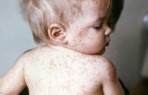 Ministerul Sănătății anunță epidemie de rujeolă în România. Trei copii sub un an au murit și la alți 675 de copii a fost confirmată boala. HARTĂ Cele mai afectate zone