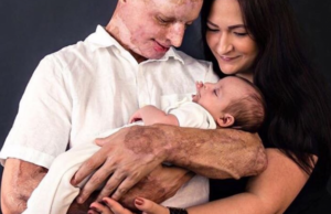 Daniel Rotaru, românul desfigurat cu acid sulfuric de fosta iubită, s-a căsătorit cu asistenta care are grijă de el