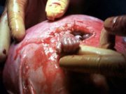 Un copil nenăscut a strâns mâna medicului chirurg