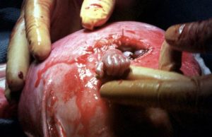 Un copil nenăscut a strâns mâna medicului chirurg