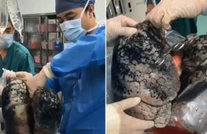 Cum arată plămânii unui bărbat care a fumat un pachet de ţigări pe zi timp de 30 de ani