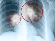 Cancer pulmonar: simptome și persoane cu risc