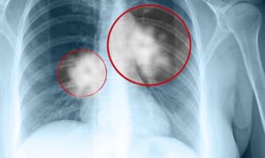 Cancer-pulmonar-simptome-persoane-cu-risc-840x500