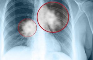 Cancer pulmonar: simptome și persoane cu risc