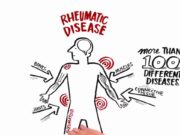 Reumatismul – tot ce trebuie să știi despre el