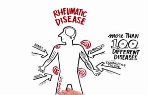 Reumatismul – tot ce trebuie să știi despre el