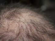 Căderea părului: cauze pe care le poți preveni