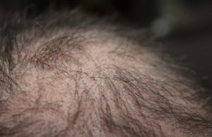 Căderea părului: cauze pe care le poți preveni