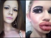 Andrea, o tânără din Bulgaria, vrea să obţină cele mai mari buze din lume