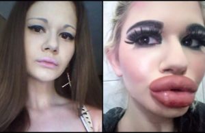 Andrea, o tânără din Bulgaria, vrea să obţină cele mai mari buze din lume