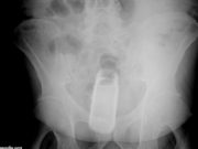 Oltean de 23 ani, adus de urgenţă la spital cu un tub de deodorant în anus. La 112 a reclamat „un accident casnic“