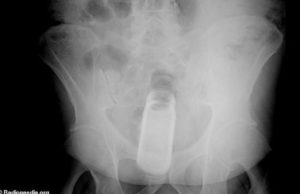 Oltean de 23 ani, adus de urgenţă la spital cu un tub de deodorant în anus. La 112 a reclamat „un accident casnic“