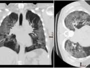 Cum arată radiografia la plămâni a unui medic infectat cu Covid-19