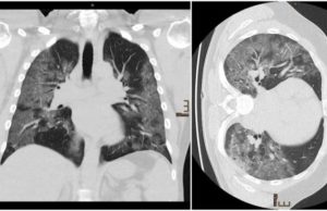 Cum arată radiografia la plămâni a unui medic infectat cu Covid-19