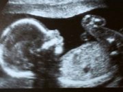 Cazul ciudat al unei fetite care s-a nascut „insarcinata” cu fratele sau geaman