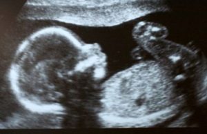 Cazul ciudat al unei fetite care s-a nascut „insarcinata” cu fratele sau geaman