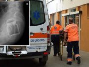 Un botoșănean care anul trecut a ajuns la spital cu un pahar in fund a venit anul acesta cu un borcan băgat acolo