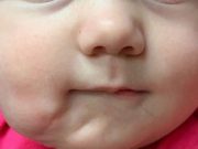 Bebelușa care i-a lăsat muți pe medici. Ce avea fetița pe obraz, la naștere: „Există doar 35 de cazuri, în istorie!”