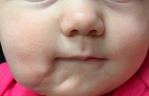 Bebelușa care i-a lăsat muți pe medici. Ce avea fetița pe obraz, la naștere: „Există doar 35 de cazuri, în istorie!”