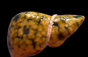 Știai că ficatul nu te doare? Iată cum îți poți da seama dacă ai ficatul bolnav