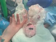 Un bebeluș născut prematur, la 490 grame, a fost ținut într-o pungă de sandviș ca să supraviețuiască, în Anglia