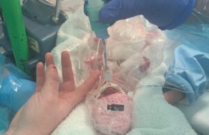 Un bebeluș născut prematur, la 490 grame, a fost ținut într-o pungă de sandviș ca să supraviețuiască, în Anglia