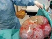Caz incredibil la Botoșani. Tumoare de 24 de kilograme, extirpată din abdomenul unei femei infectată cu COVID-19