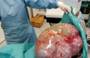 Caz incredibil la Botoșani. Tumoare de 24 de kilograme, extirpată din abdomenul unei femei infectată cu COVID-19