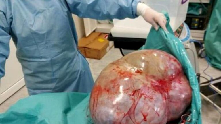 Caz incredibil la Botoșani. Tumoare de 24 de kilograme, extirpată din abdomenul unei femei infectată cu COVID-19