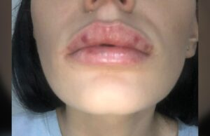 Mărturiile tulburătoare ale fetelor mutilate de falși chirurgi esteticieni, în București: „Ca şi cum mă muşcaseră vreo 7 albine”