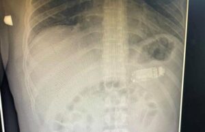 Un deținut s-a plâns de dureri de stomac mai multe zile. Incredibil i-au găsit medicii în stomac