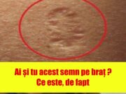 Probabil ai observat si tu ca exista anumite persoane care au o cicatrice rotunda in partea de sus a bratelor. Probabil o ai si tu