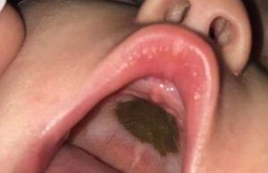 A descoperit o pată neagră în gura fiicei sale și a mers într-un suflet la Urgențe. Acolo a ajuns de râsul unui spital întreg când medicii au aflat ce e, de fapt –»