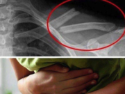 Otrava asta îţi distruge oasele! O consumi în fiecare zi fără să știi cât de toxică este pentru organism. Medicii trag un semnal de alarmă – >>