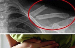 Otrava asta îţi distruge oasele! O consumi în fiecare zi fără să știi cât de toxică este pentru organism. Medicii trag un semnal de alarmă – >>