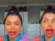 O tânără care și-a injectat prea mult acid hialuronic în buze timp de cinci ani, a decis să-l dizolve pe tot! Cum a reacționat iubitul ei după ce i-a văzut transformarea