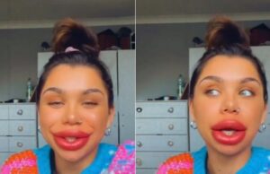 O tânără care și-a injectat prea mult acid hialuronic în buze timp de cinci ani, a decis să-l dizolve pe tot! Cum a reacționat iubitul ei după ce i-a văzut transformarea