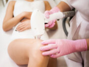 De ce epilarea definitivă nu e definitivă?