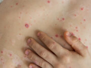 Un virus care părea că a dispărut în ultimii ani a început să se răspândească România. Județul unde apar tot mai multe cazuri –>>