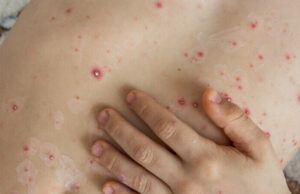 Un virus care părea că a dispărut în ultimii ani a început să se răspândească România. Județul unde apar tot mai multe cazuri –>>