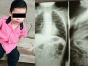 Un copil de doi ani a înghițit o baterie care a explodat în interiorul lui