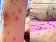 Incident grav, în căminele din Regie: o studentă a ajuns la spital din cauza mușăturilor de ploșnițe! Administrația, reacție șoc: ”O nespălată!”