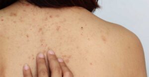 Pete-maronii-pe-spate