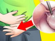 Tipul de cancer care le păcălește pe toate femeile. La ce să fii atentă