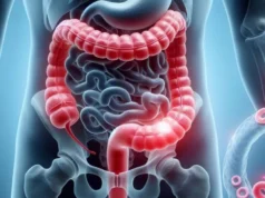 Cancerul de colon are simptome diferite la femei și bărbați