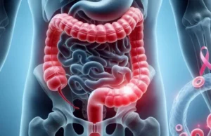 Cancerul de colon are simptome diferite la femei și bărbați