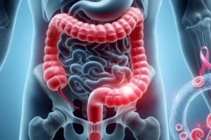 cancer-de-colon-1-930x620